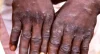 NCDC reports 66 suspected cases of monkeypox, with one death