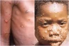 Lassa fever kills 170 Nigerians, Monkeypox 6